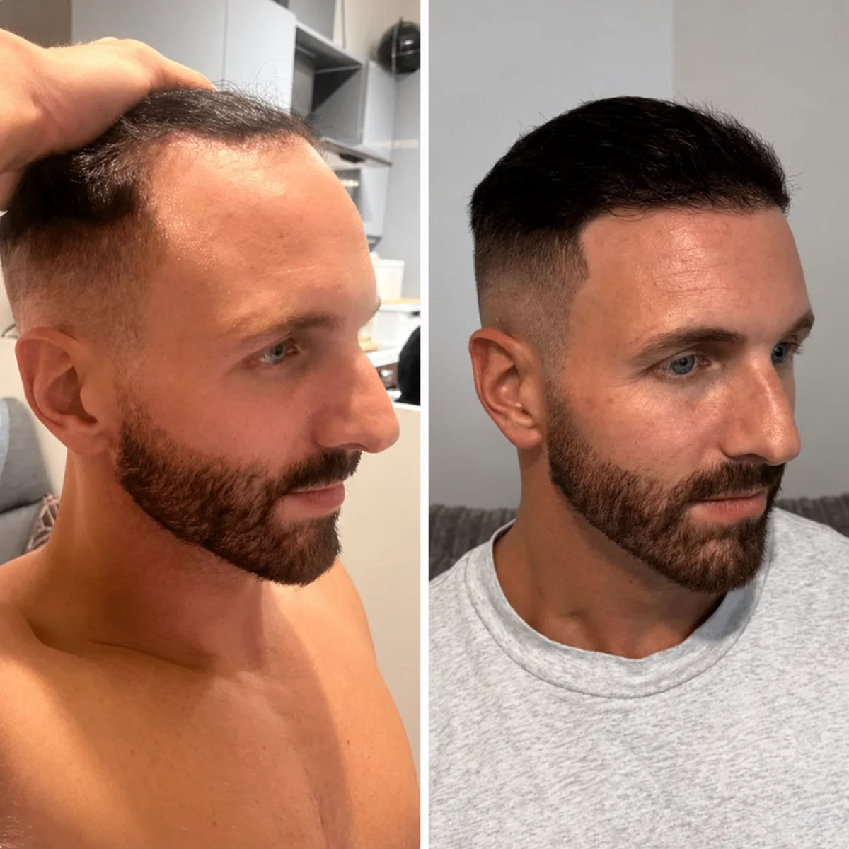 Hiustenkasvuseerumi roll-on – ohuille hiuksille